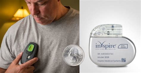 Inspire Sleep Apnea Device Review 2024 .